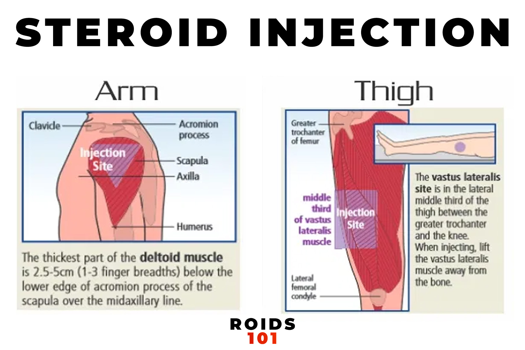 how to inject steroids guide 4