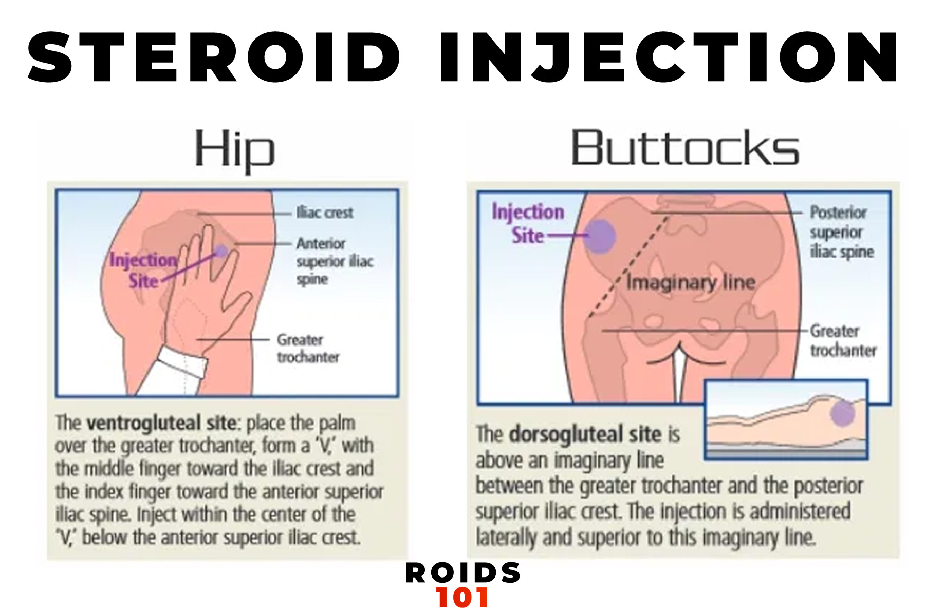 how to inject steroids guide 5